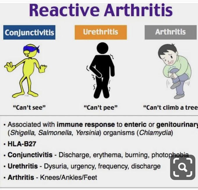 Reactive Arthritis