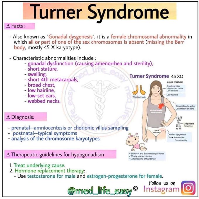 turner syndrome facts