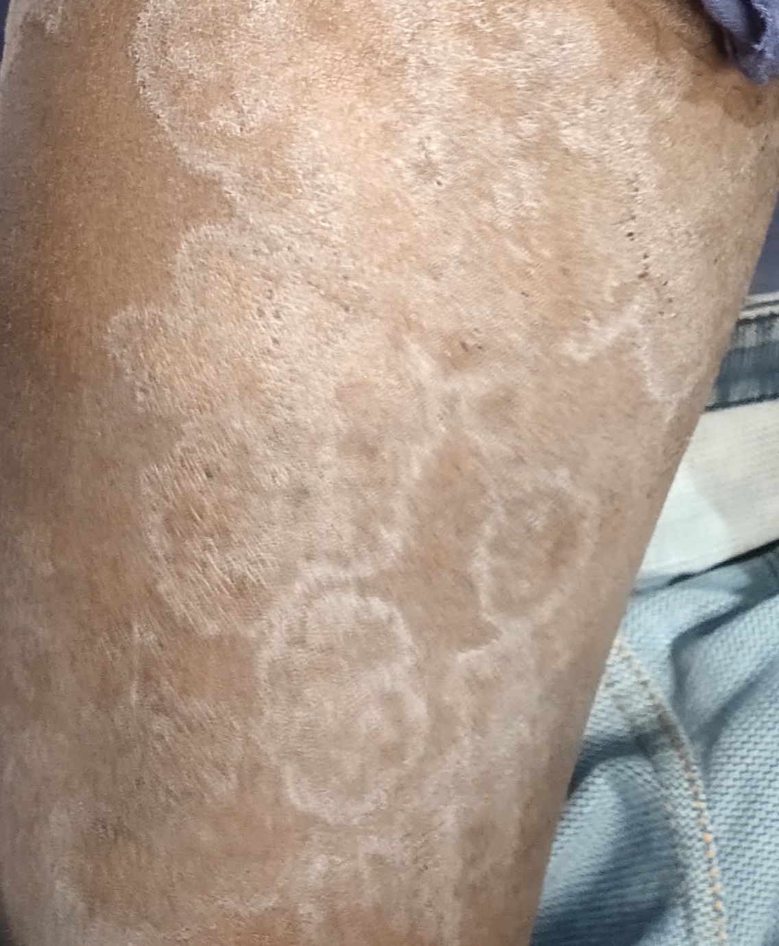 Tinea corporis - MEDizzy