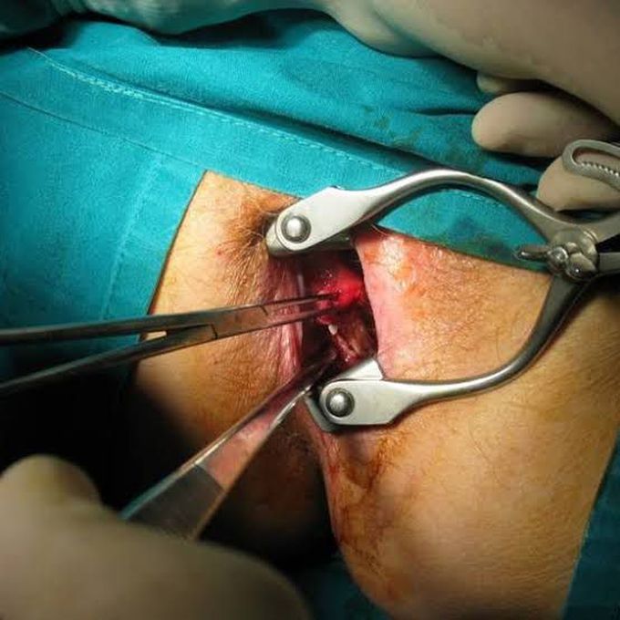 Transanal excision