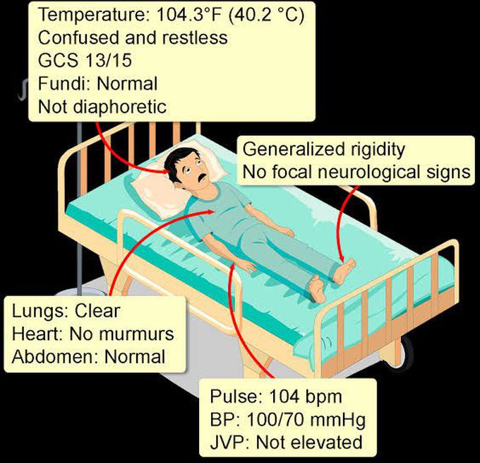 Neuroleptic malignant syndrome