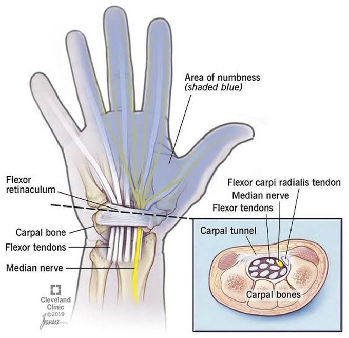 Carpal tunnel syndrome