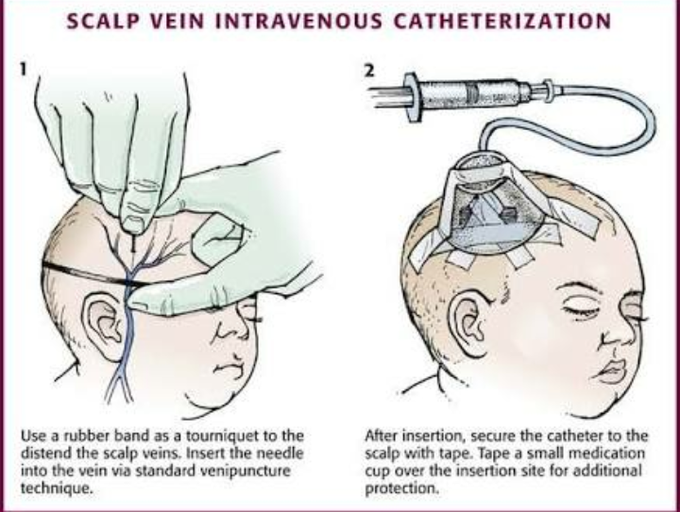 Iv therapy in neonate
