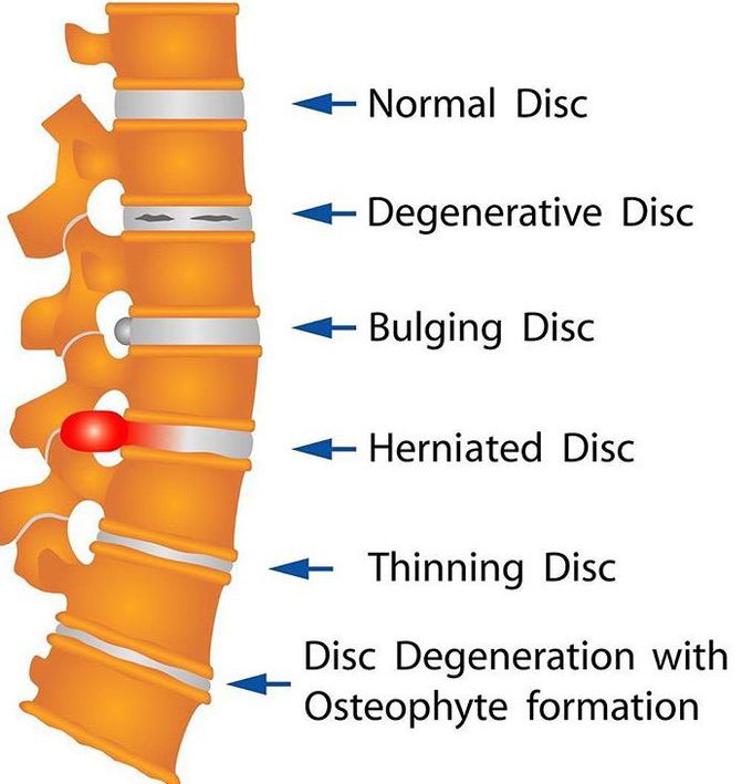 Disc changes