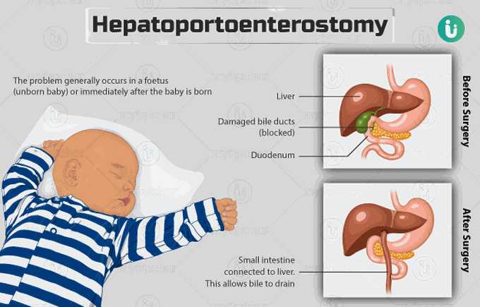 Hepatoportoenterostomy (Kasai Procedure)