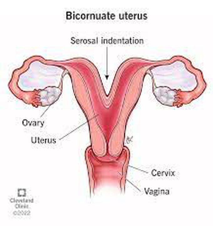 What causes a bicornuate uterus?