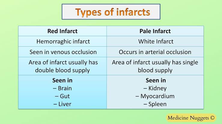 Types of infarct - MEDizzy