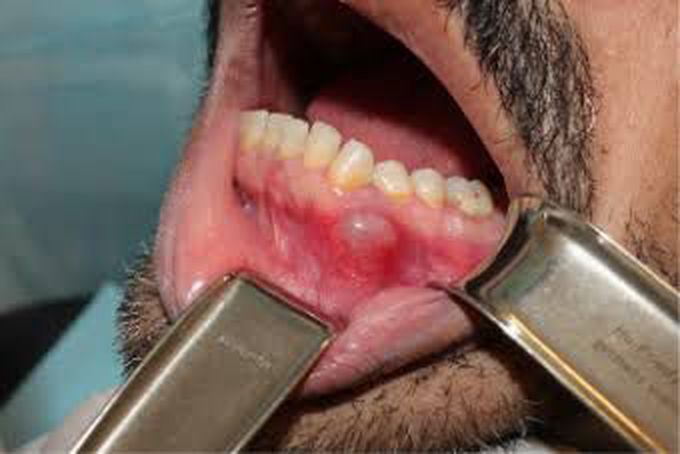 Lateral periodontal cyst