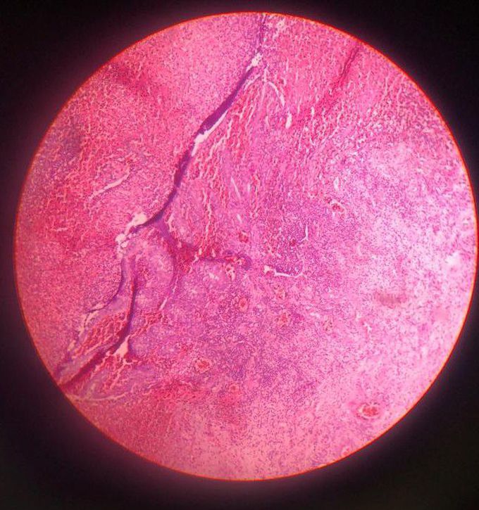 Find the histopathology