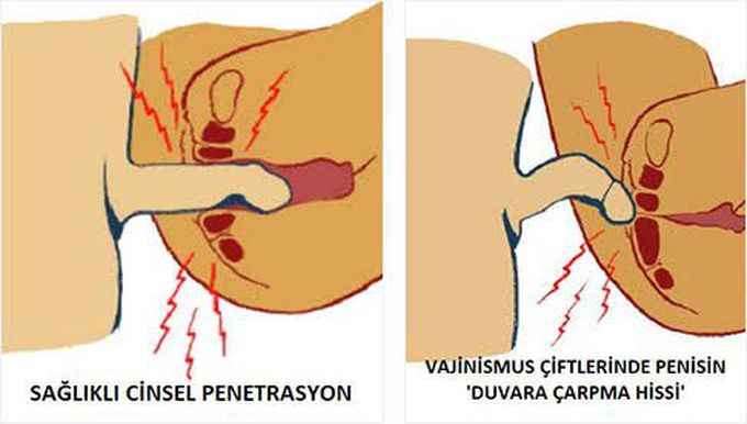 Vaginismus