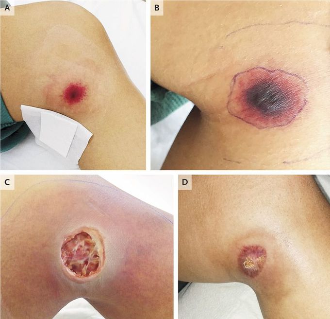 Ecthyma Gangrenosum