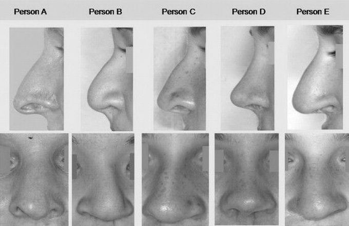 Different types of Nasal deformities