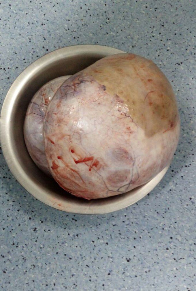 This is an 8kg ovarian cyst.