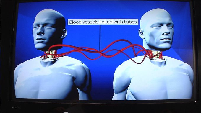 World's First Head Transplant: What's Involved?