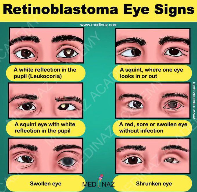 Retinoblastoma- eye signs