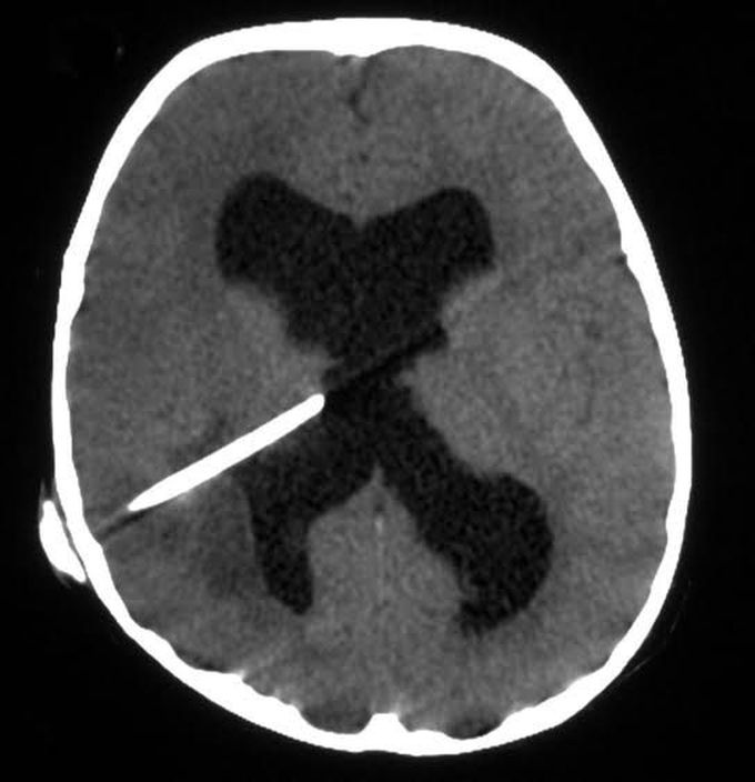 Brain abscess