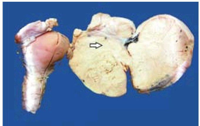 Solid ovarian tumour