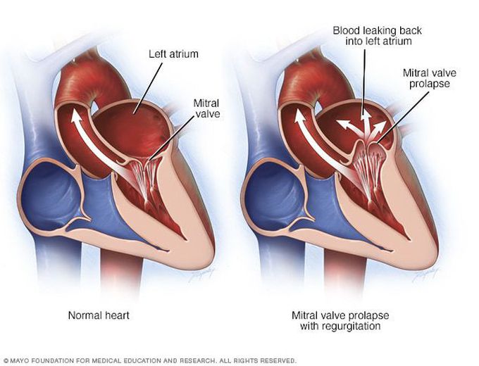 Barlow’s Disease