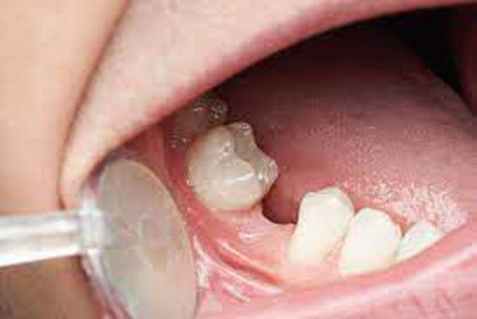 How is hypodontia diagnosed?