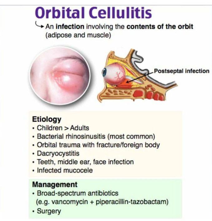 anatomy orbital cellulitis