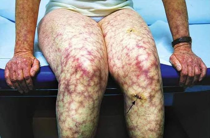 Types of livedo reticularis