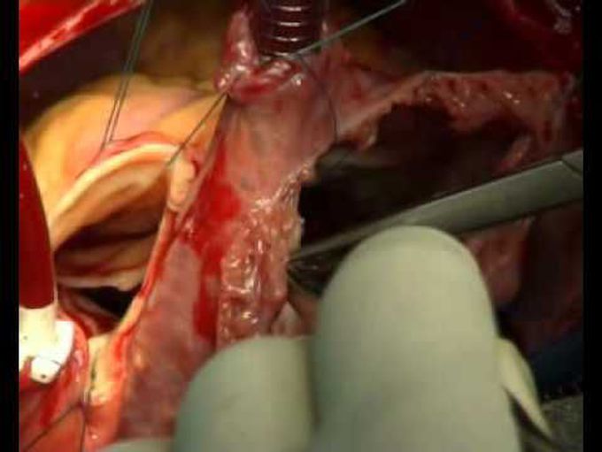 Repair of Ruptured Sinus of Valsalva Aneurysm