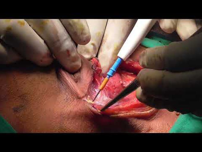 Infrahyoid flap harvest