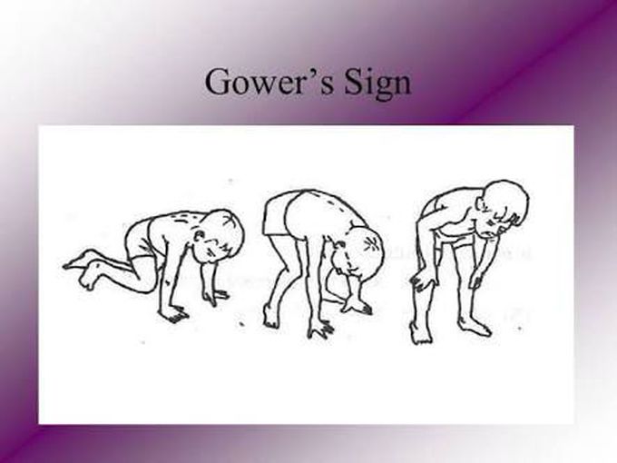 Gower's sign