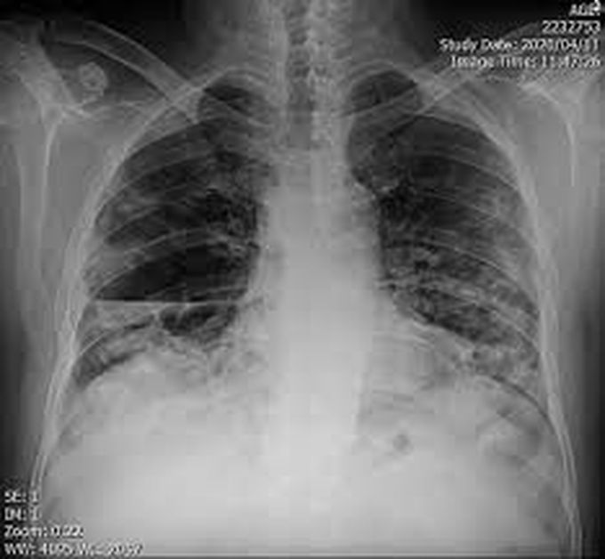 Treatment of lung abscess