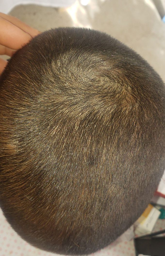 Tinea capitis