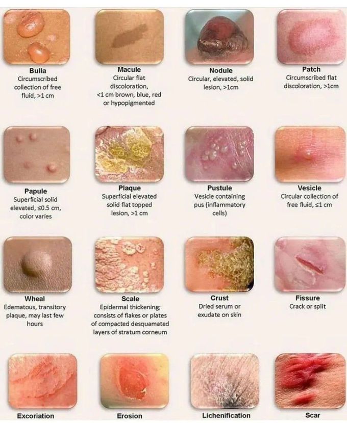 Skin Lesions