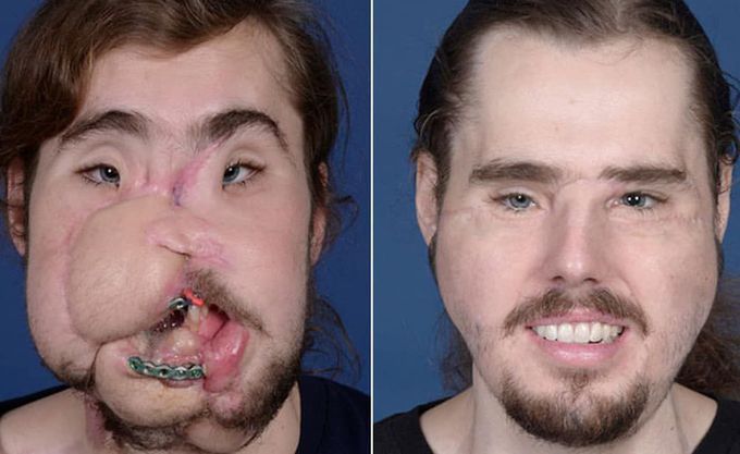 26-year old face transplant patient reveals new face! 