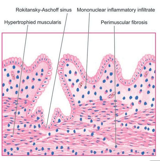 Chronic cholecystitis, microscopic appearance.