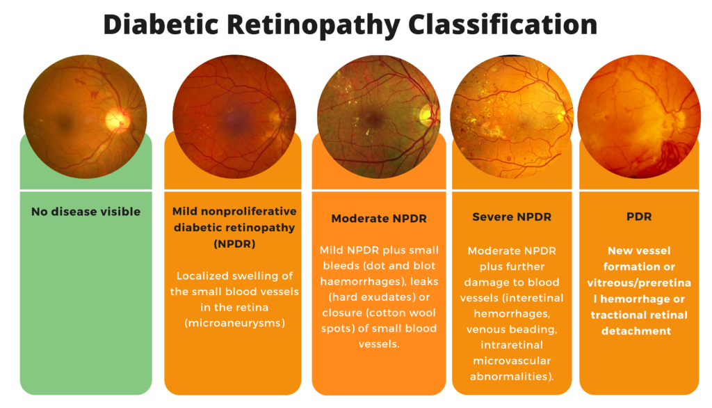 Diabetic Retinopathy Classification MEDizzy
