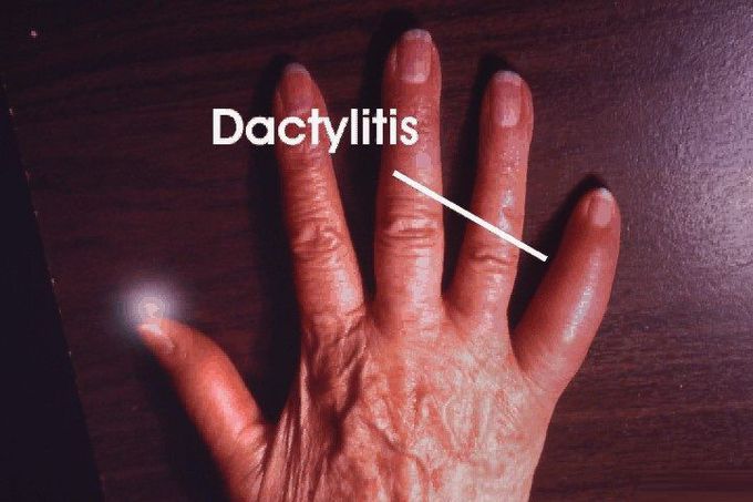 Dactylitis🖖🏻