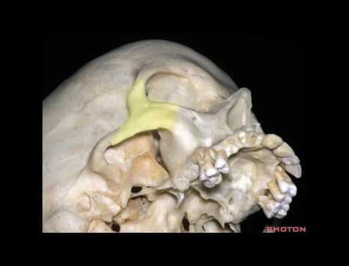 Orbitozygomatic Approaches