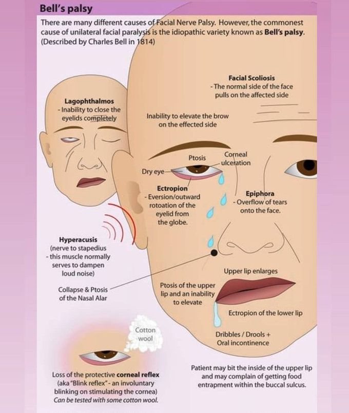 Bells palsy explanation