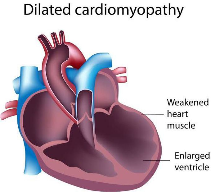 Complications of dilated cardiomyopathy
