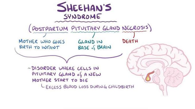 Sheehan syndrome