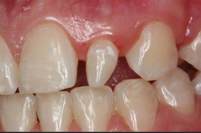 Peg lateral incisor