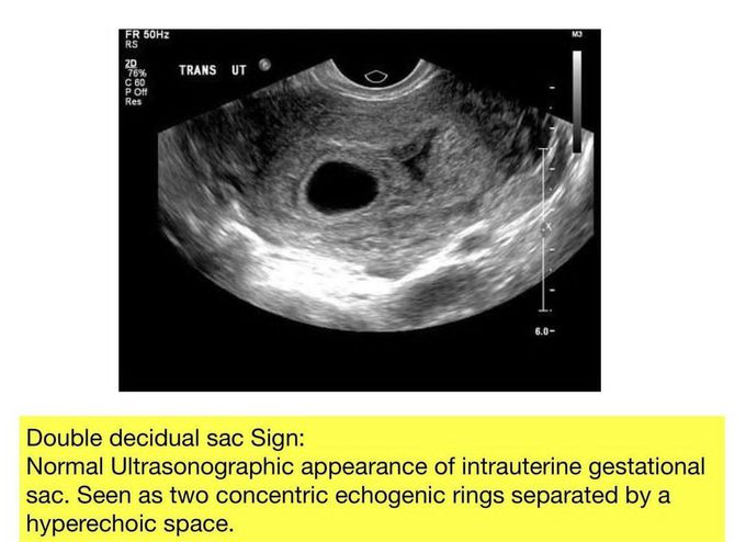 Double Decidual Sac Sign