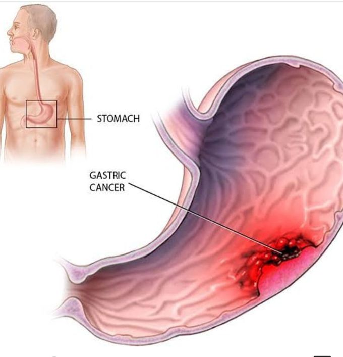 Stomach cancers