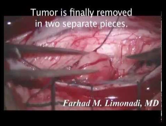 Spinal Cord Tumor Neurofibroma: Surgery and Removal (spine surgery)