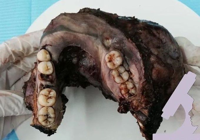 Ameloblastoma