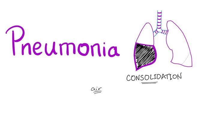 A Discussion on Pneumonia