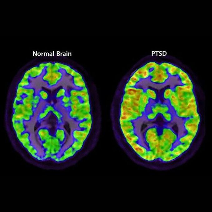 PTSD and Dementia