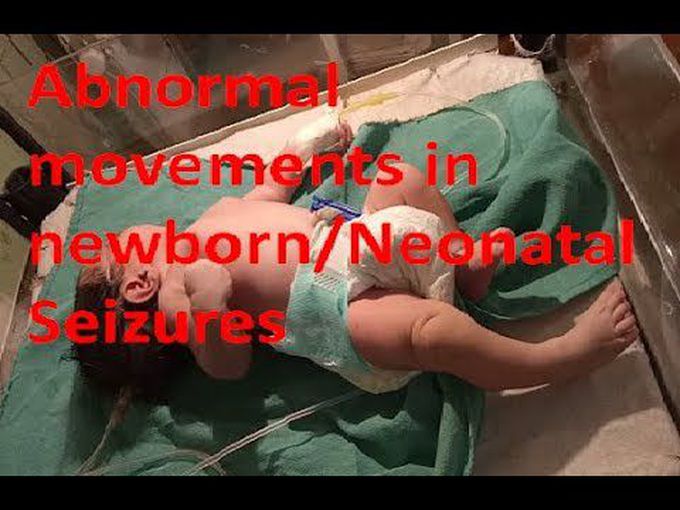 Neonatal seizure/Subtle seizure