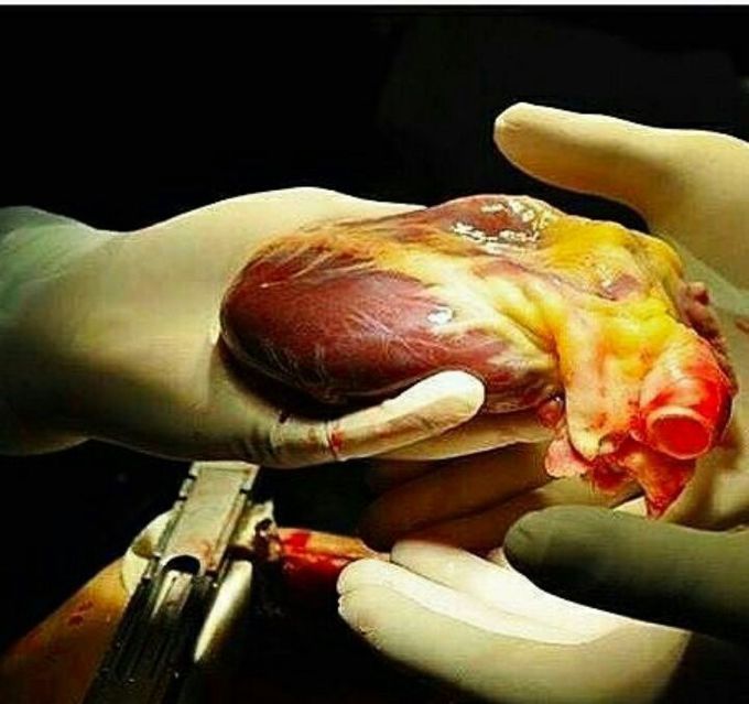 Transplantation...