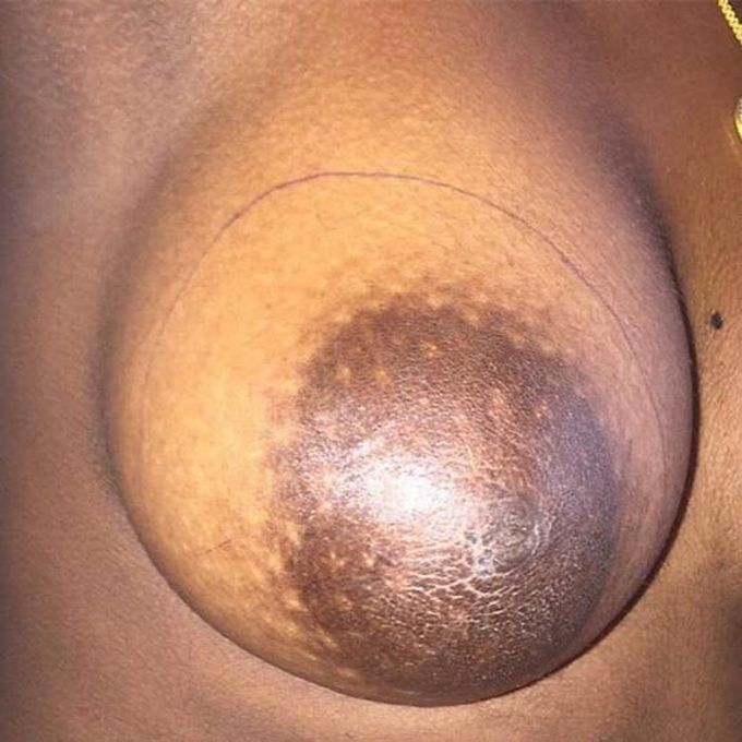 Gaint fibroadenoma breast cancer