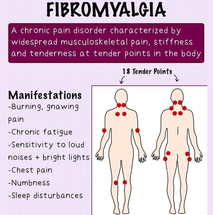 Fibromyalgia